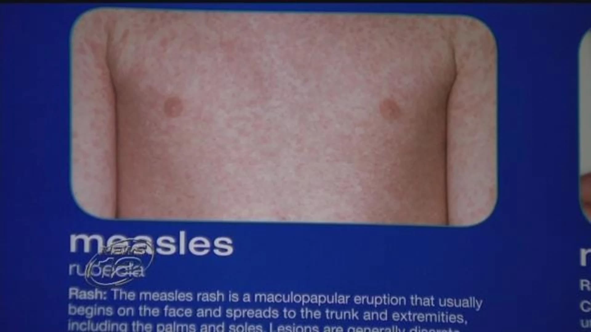 Measles outbreak grows in Rockland County