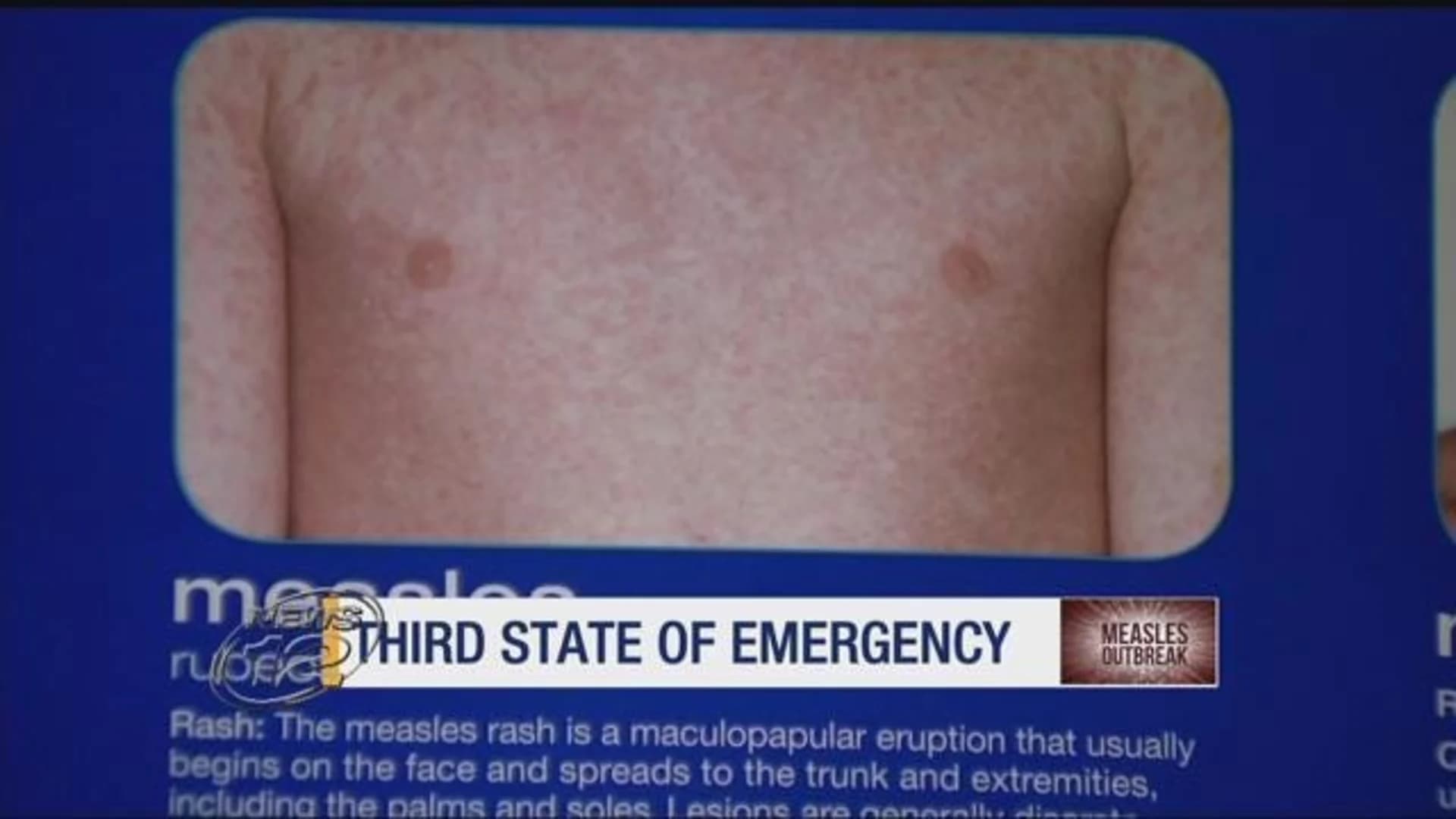 Rockland extends measles state of emergency