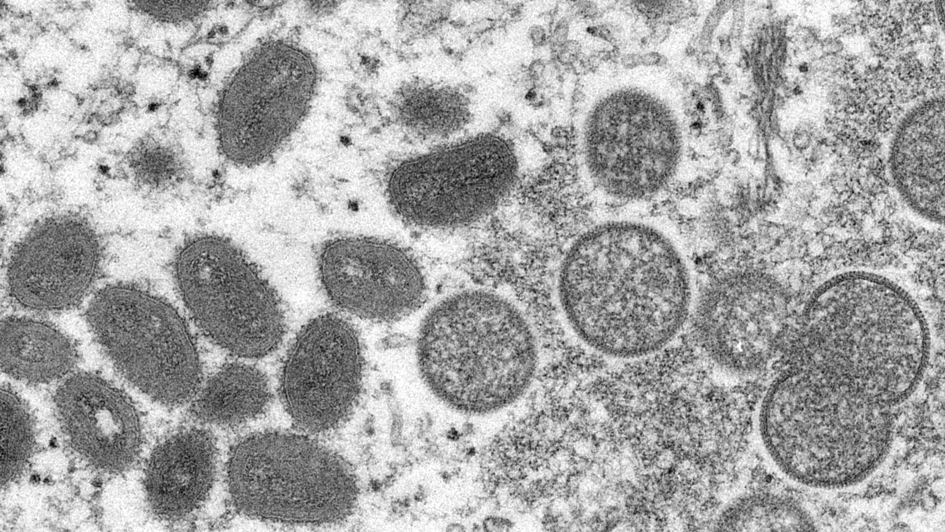 CDC: Labcorp begins testing for monkeypox, doubling U.S. testing capacity